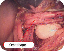 Oesophage